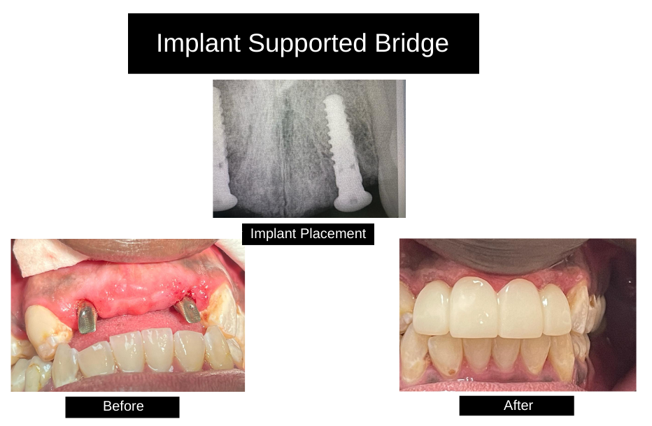 Dental Implants Nassau, Bahamas The Bahamas center for Gum Diseases